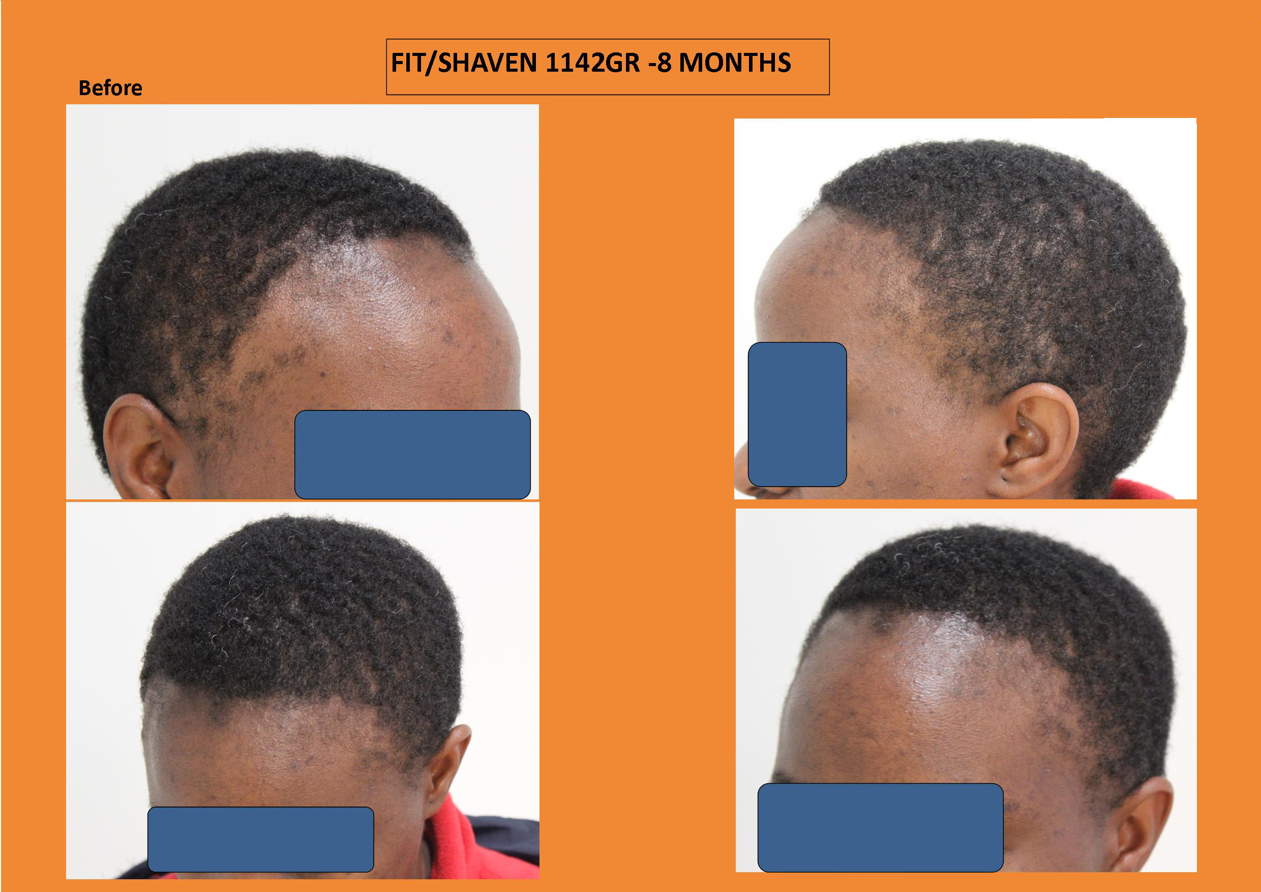 Afrikaner - Africans Haartransplantation vorher1